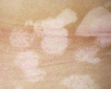 临床可以准确检查白癜风的方式是什么