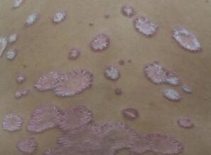 牛皮癣的诊断需要从哪些方面进行